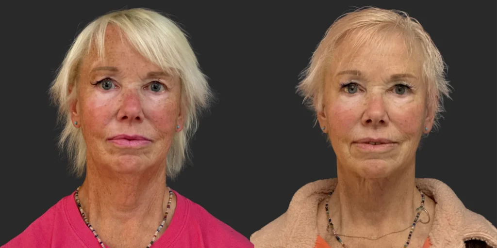 Cameo 3 Facelift #010, before and after photo