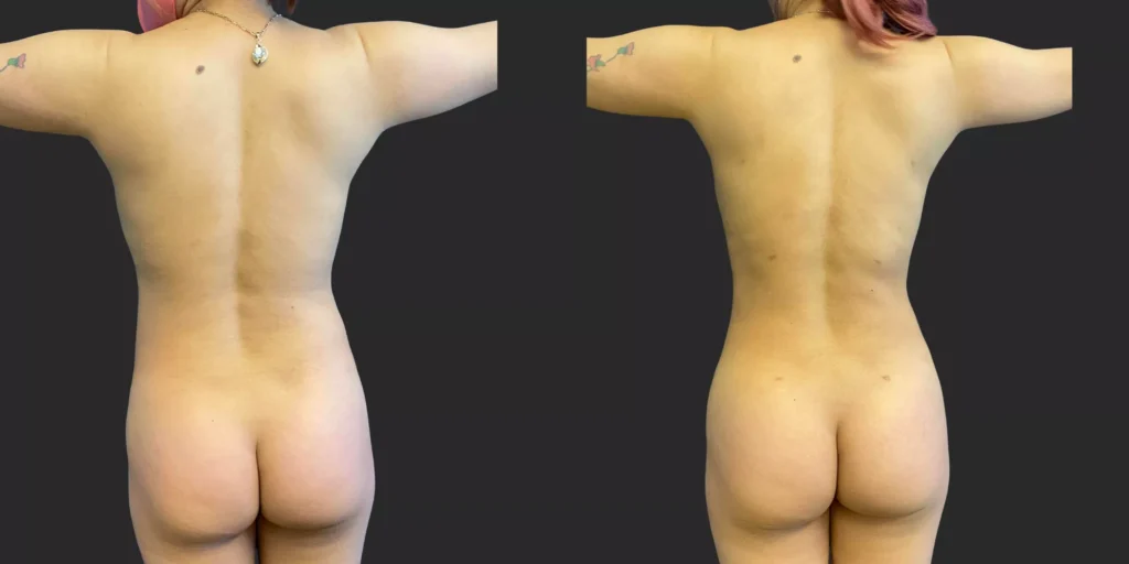 360 LBA plus armpits #033, before and after photo, view 3