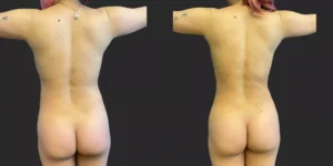 360 LBA plus armpits #033, before and after photo, view 3
