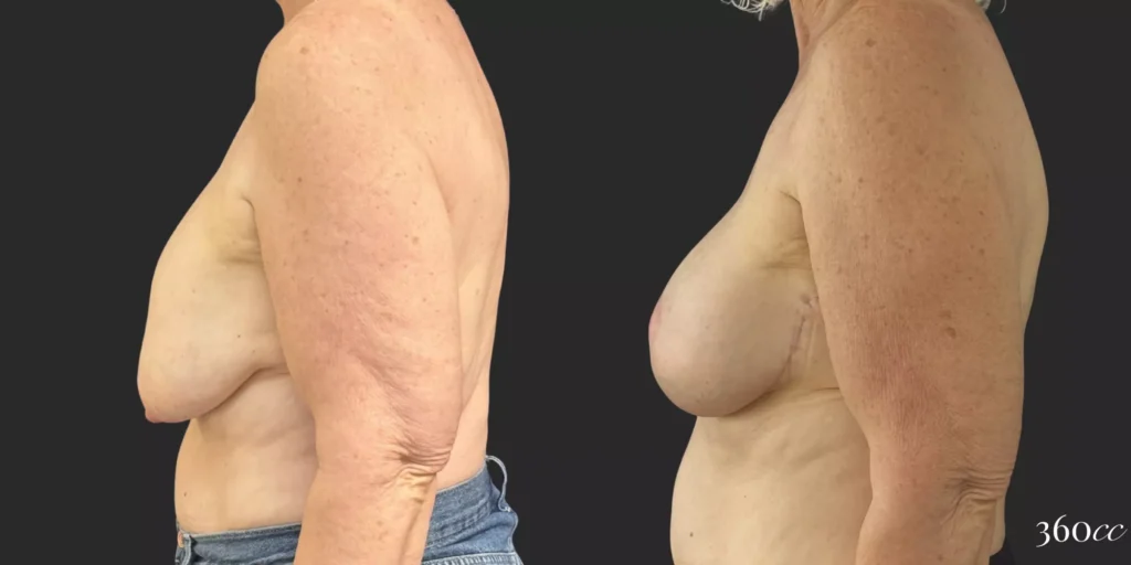 Bilateral Implant Exchange and Bilateral Mastopexy  #005, before and after photo, view 3