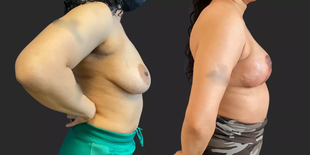 Bilateral Mastopexy  #018, before and after photo, view 3