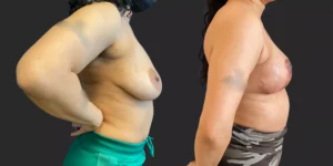 Bilateral Mastopexy  #018, before and after photo, view 3