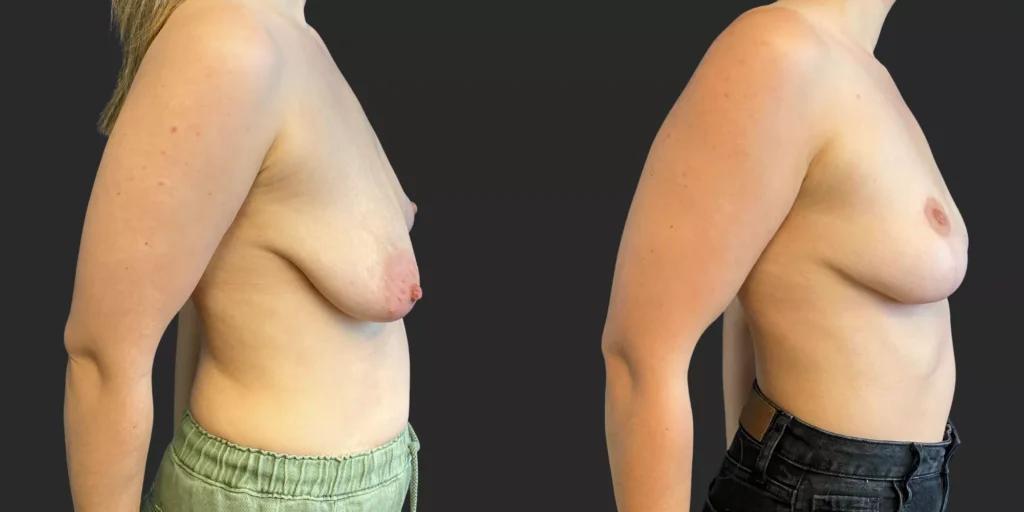 Bilateral Mastopexy  #015, before and after photo, view 3