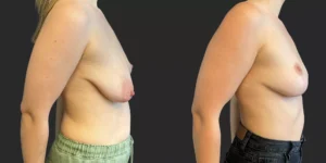 Bilateral Mastopexy  #015, before and after photo, view 3