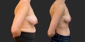 Bilateral Mastopexy  #012, before and after photo, view 3