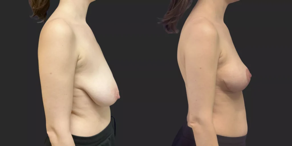 Bilateral Mastopexy  #008, before and after photo, view 3