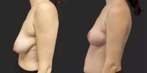 Bilateral Mastopexy  #006, before and after photo, view 3