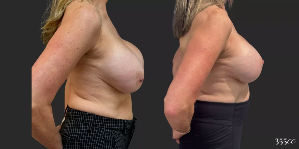 Bilateral Mastopexy and Bilateral Implant Exchange  #011, before and after photo, view 3