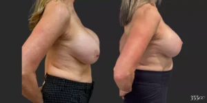 Bilateral Mastopexy and Bilateral Implant Exchange  #011, before and after photo, view 3