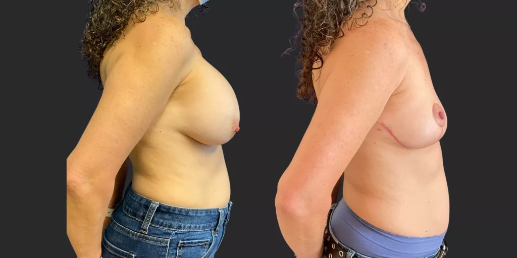 Bilateral Breast Implant Removal + Mastopexy #020, before and after photo, view 3