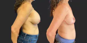 Bilateral Breast Implant Removal + Mastopexy #020, before and after photo, view 3