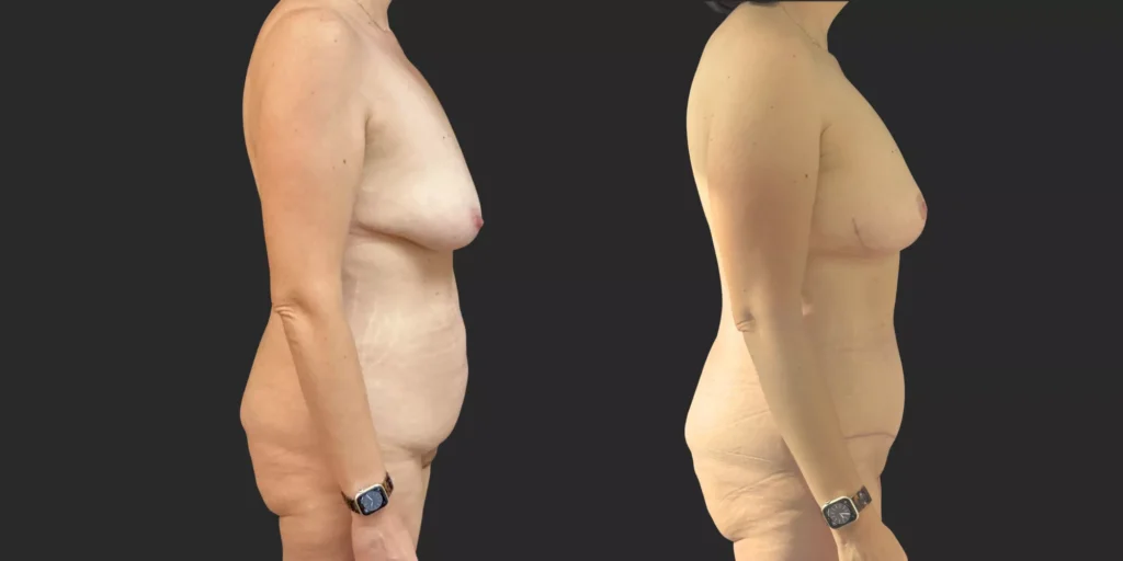 Abdominoplasty with Bilateral Mastopexy  #009, before and after photo, view 3