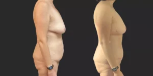 Abdominoplasty with Bilateral Mastopexy  #009, before and after photo, view 3