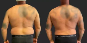 360 Lipo and Gynecomastia Reduction #005, before and after photo, view 3
