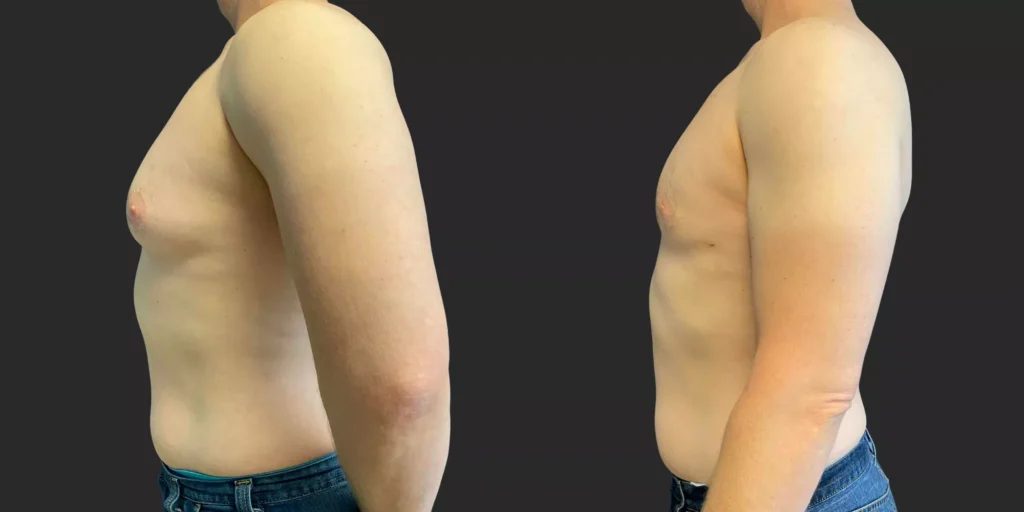Gynecomastia Reduction #006, before and after photo, view 3