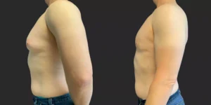 Gynecomastia Reduction #006, before and after photo, view 3