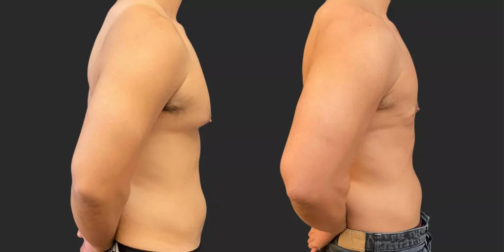Gynecomastia Reduction with Lipo #003, before and after photo, view 3