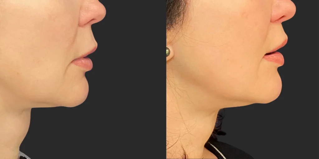Lip Lift #016, before and after photo, view 3