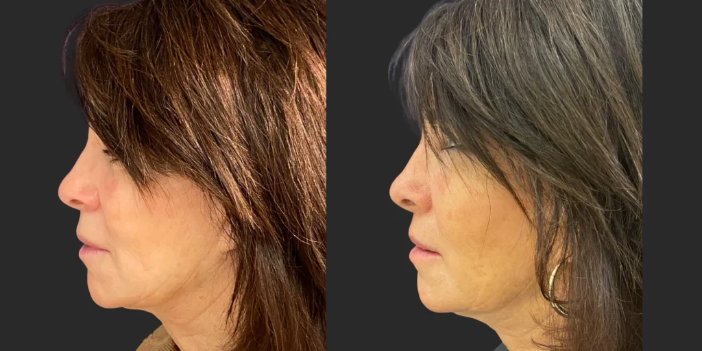 Lip Lift #021, before and after photo, view 3