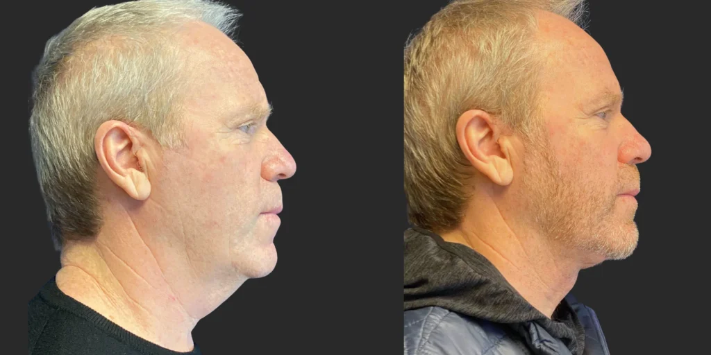 Cameo 2 Necklift #022, before and after photo, view 3