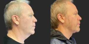 Cameo 2 Necklift #022, before and after photo, view 3