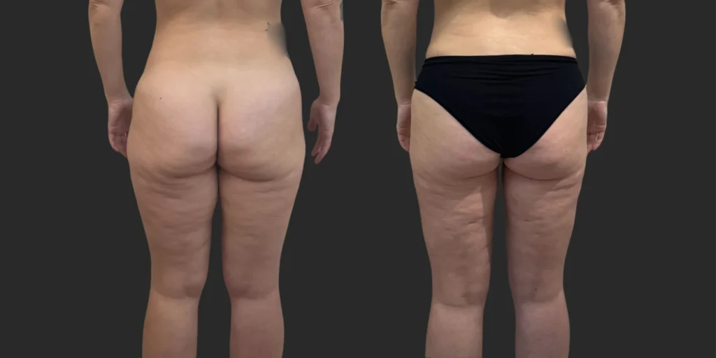 Lipo of Inner/Outer Thighs + Knees with Fat Transfer to Breasts #034, before and after photo, view 4