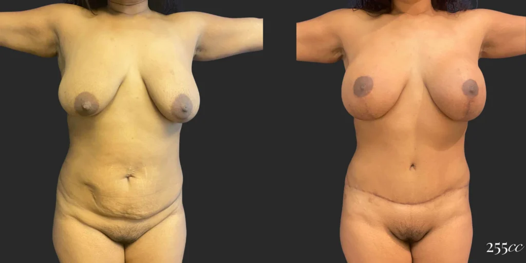 Abdominoplasty with Mastopexy and Breast Augmentation #004, before and after photo