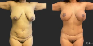 Abdominoplasty with Mastopexy and Breast Augmentation #004, before and after photo