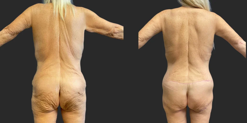 Belt Lipectomy and Thigh Lifts #002, before and after photo