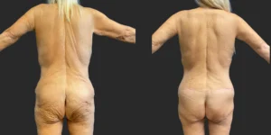 Belt Lipectomy and Thigh Lifts #002, before and after photo