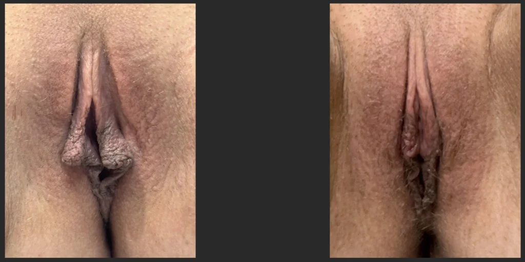 Labiaplasty #025, before and after photo