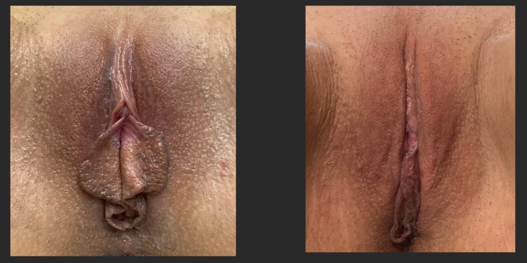 Labiaplasty #028, before and after photo