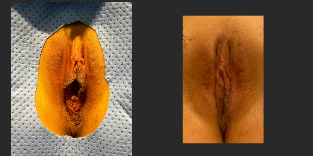 Labiaplasty #029, before and after photo