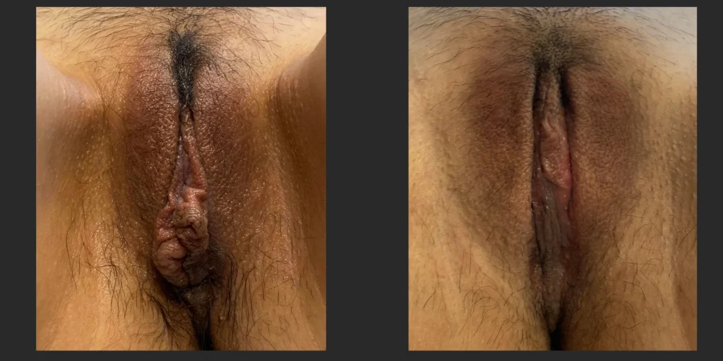 Labiaplasty #031, before and after photo