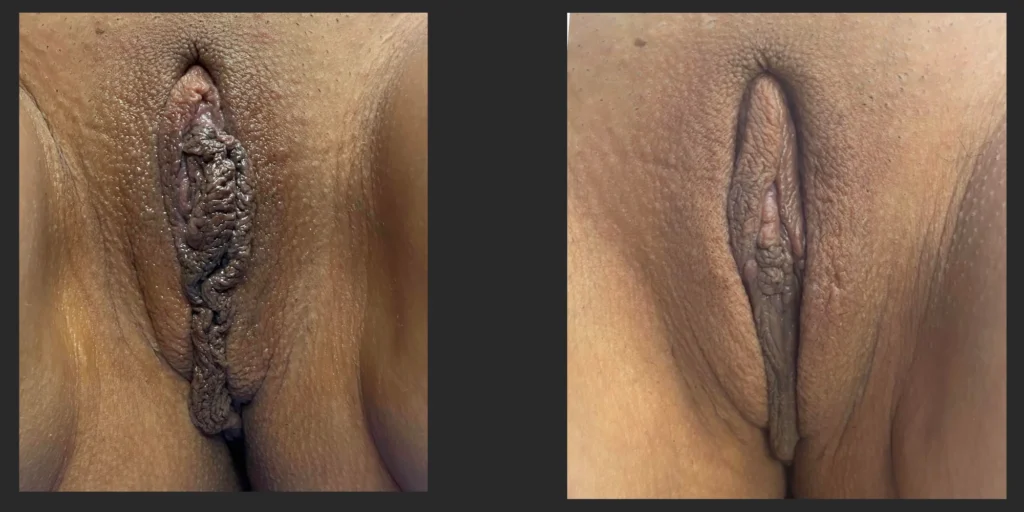 Labiaplasty #032, before and after photo