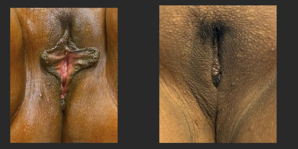 Labiaplasty #033, before and after photo