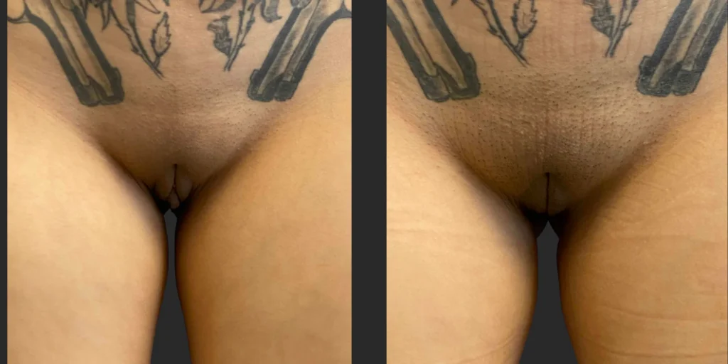 Labiaplasty #034, before and after photo