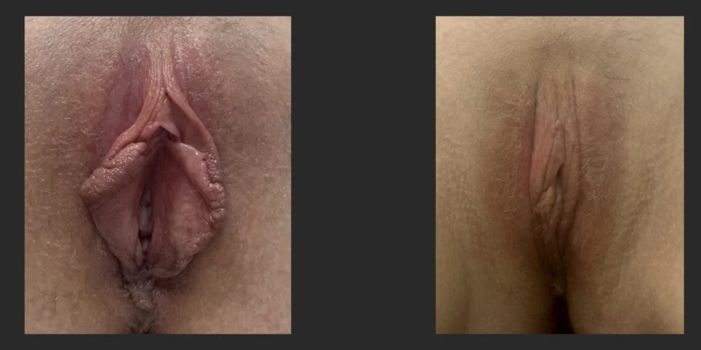 Labiaplasty #021, before and after photo