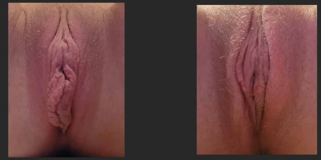 Labiaplasty #022, before and after photo