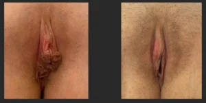 Labiaplasty #023, before and after photo