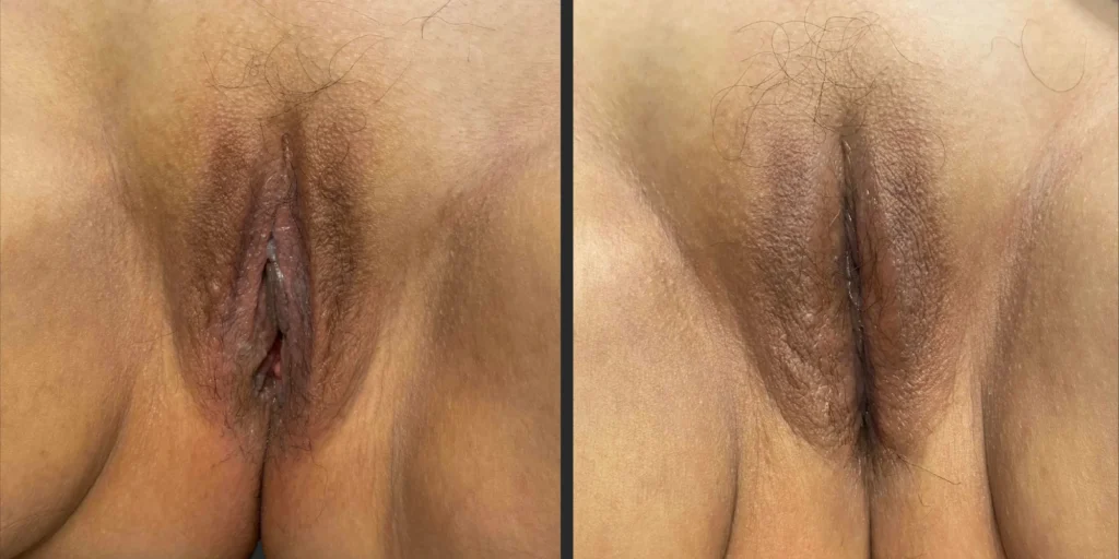 Labiaplasty of Labia Majora #030, before and after photo