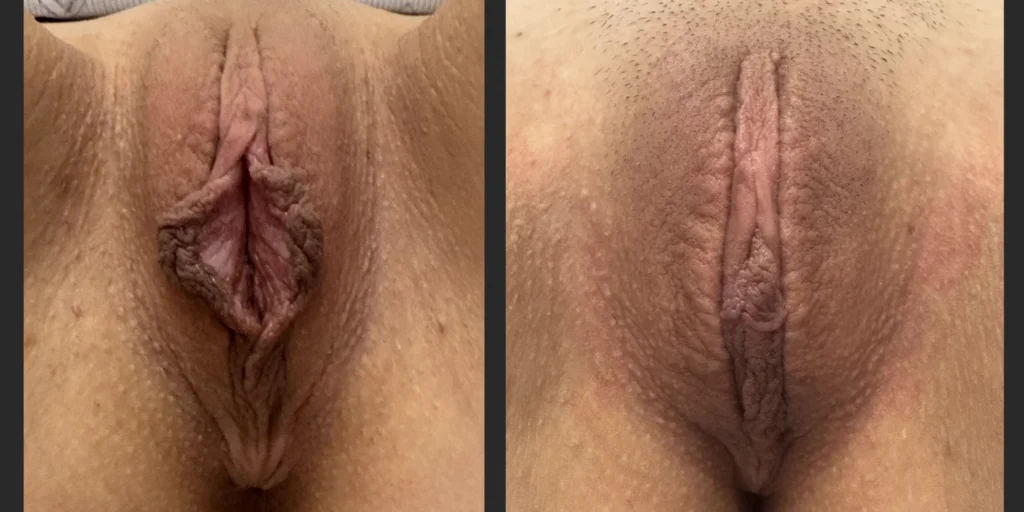Labiaplasty with Clitoral Head Reduction Case #024, before and after photo