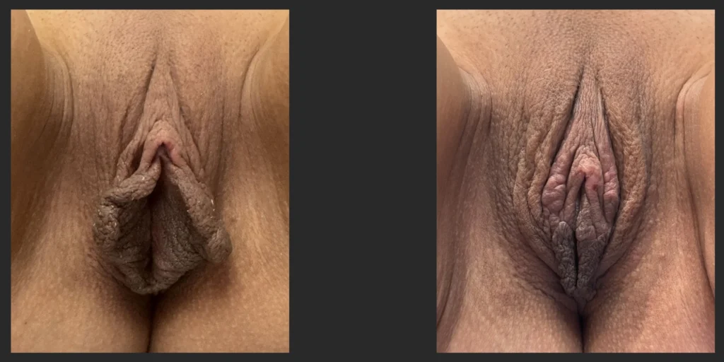 Labiaplasty with Clitoral head Reduction #026, before and after photo