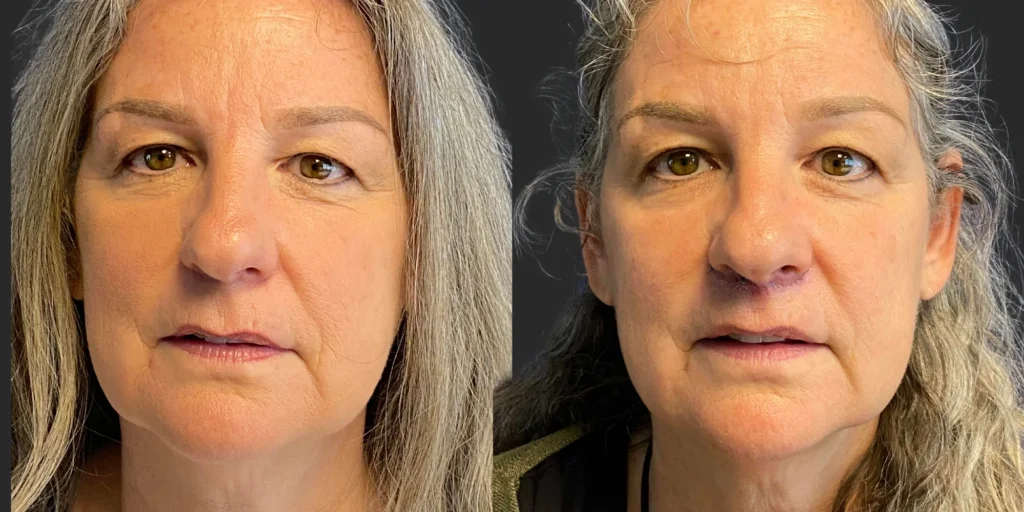 Lip Lift #018, before and after photo