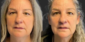 Lip Lift #018, before and after photo