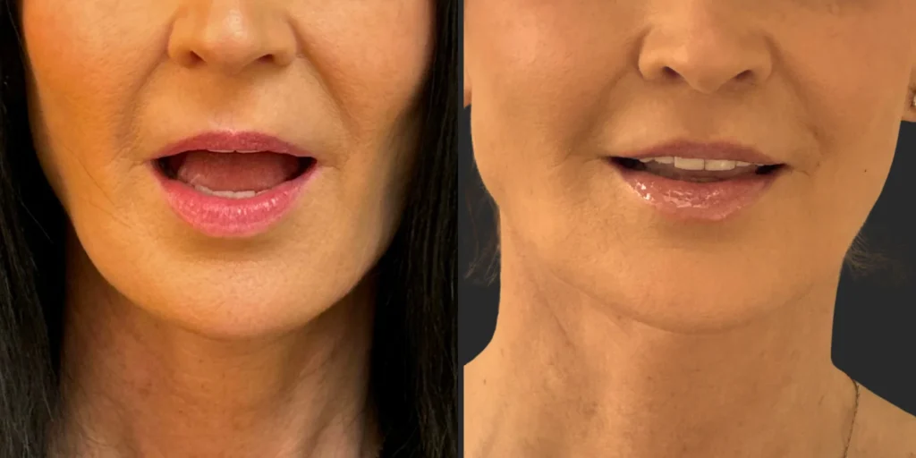 Lip Lift #011, before and after photo