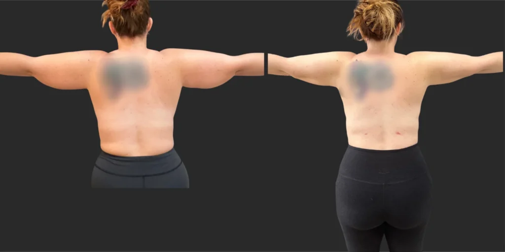 Lipo of Upper Arms and Back Bra Roll #033, before and after photo