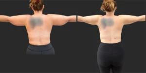 Lipo of Upper Arms and Back Bra Roll #033, before and after photo