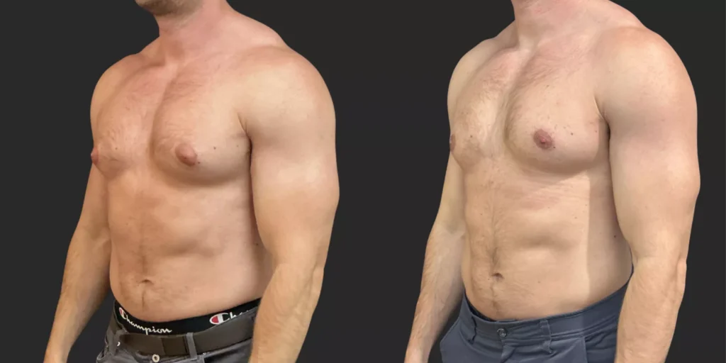 Gynecomastia 41 6aa16b055caee