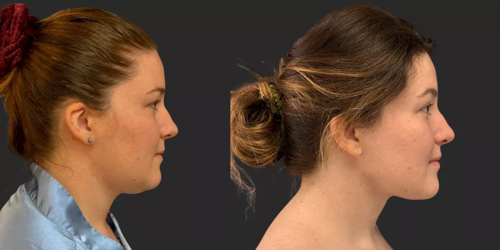 Chin Liposuction #003, before and after photo